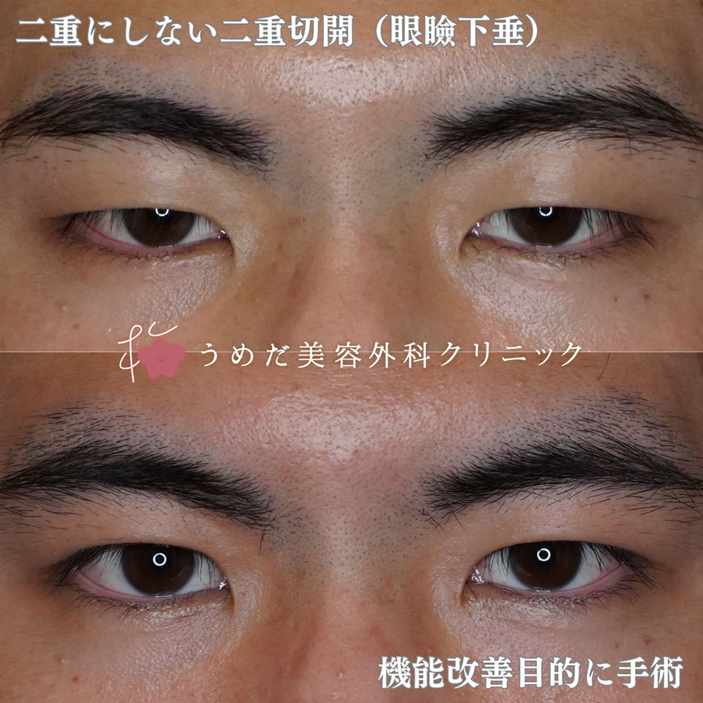 一重のまま眼瞼下垂1
