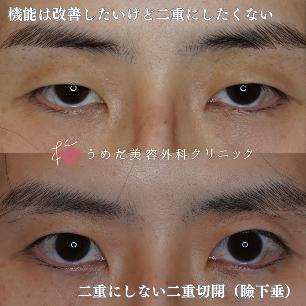 一重のまま眼瞼下垂2