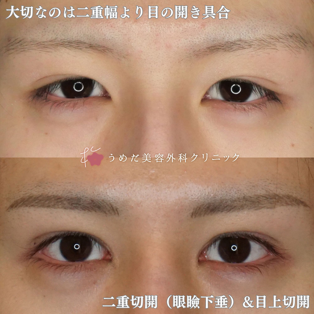 眼瞼下垂1