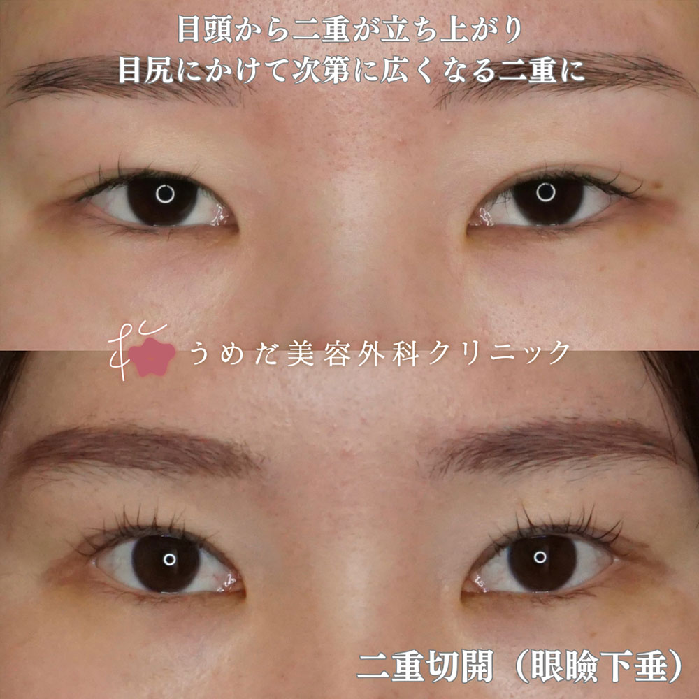眼瞼下垂2
