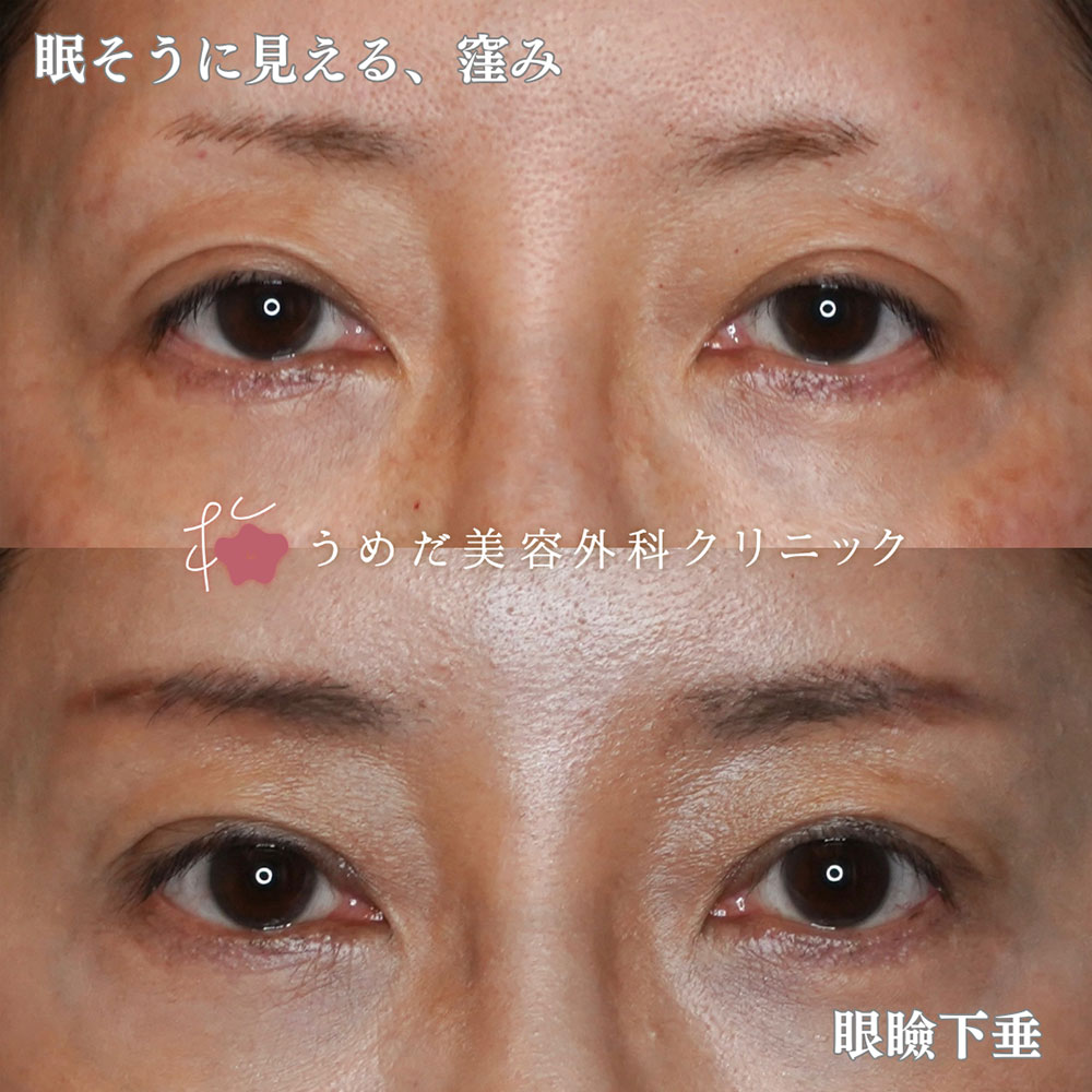 眼瞼下垂3