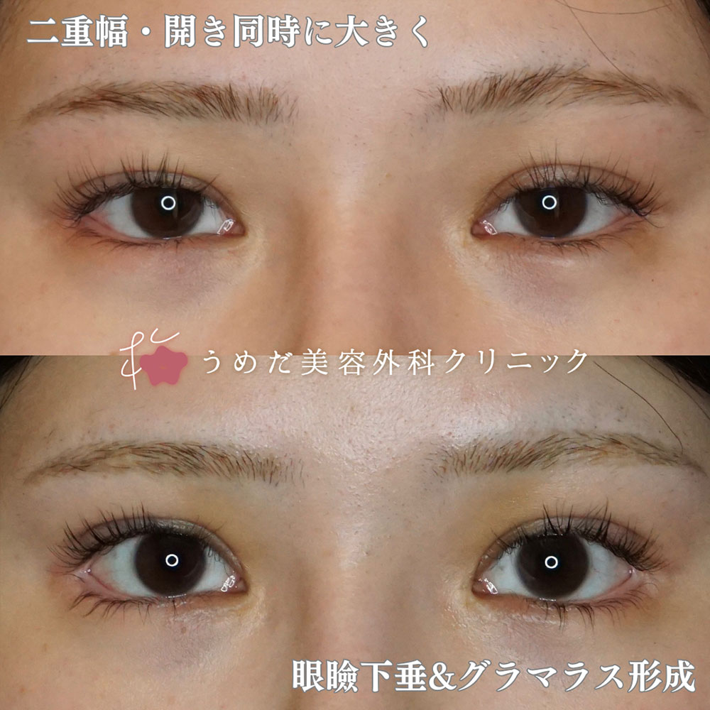 眼瞼下垂4