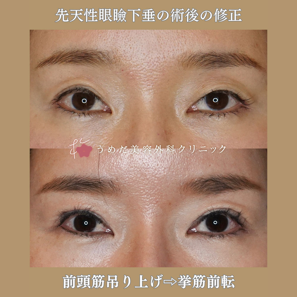 食い込みが浅い
