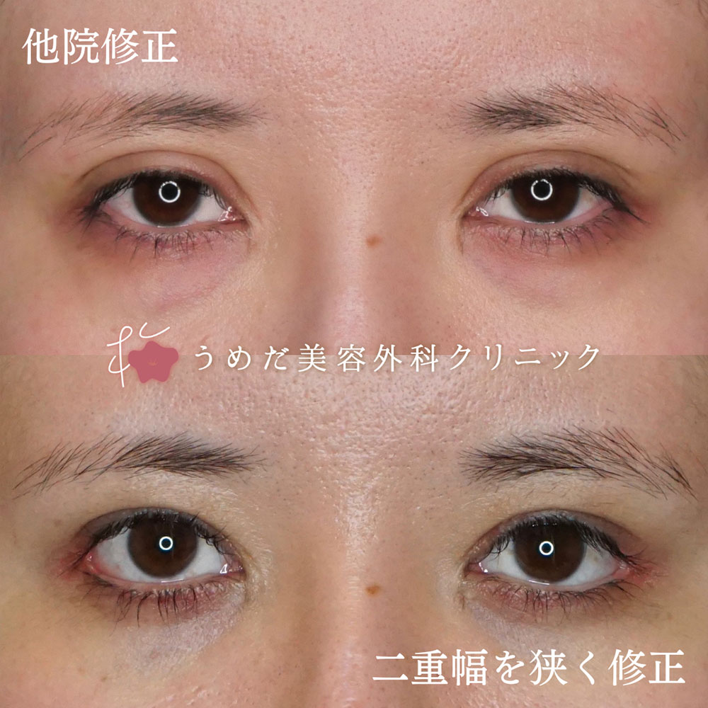 二重幅が広い
