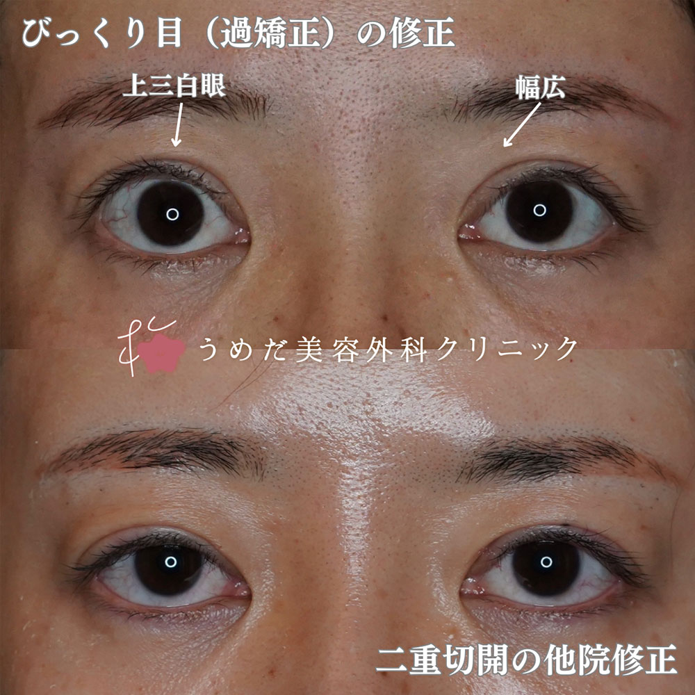 過矯正2