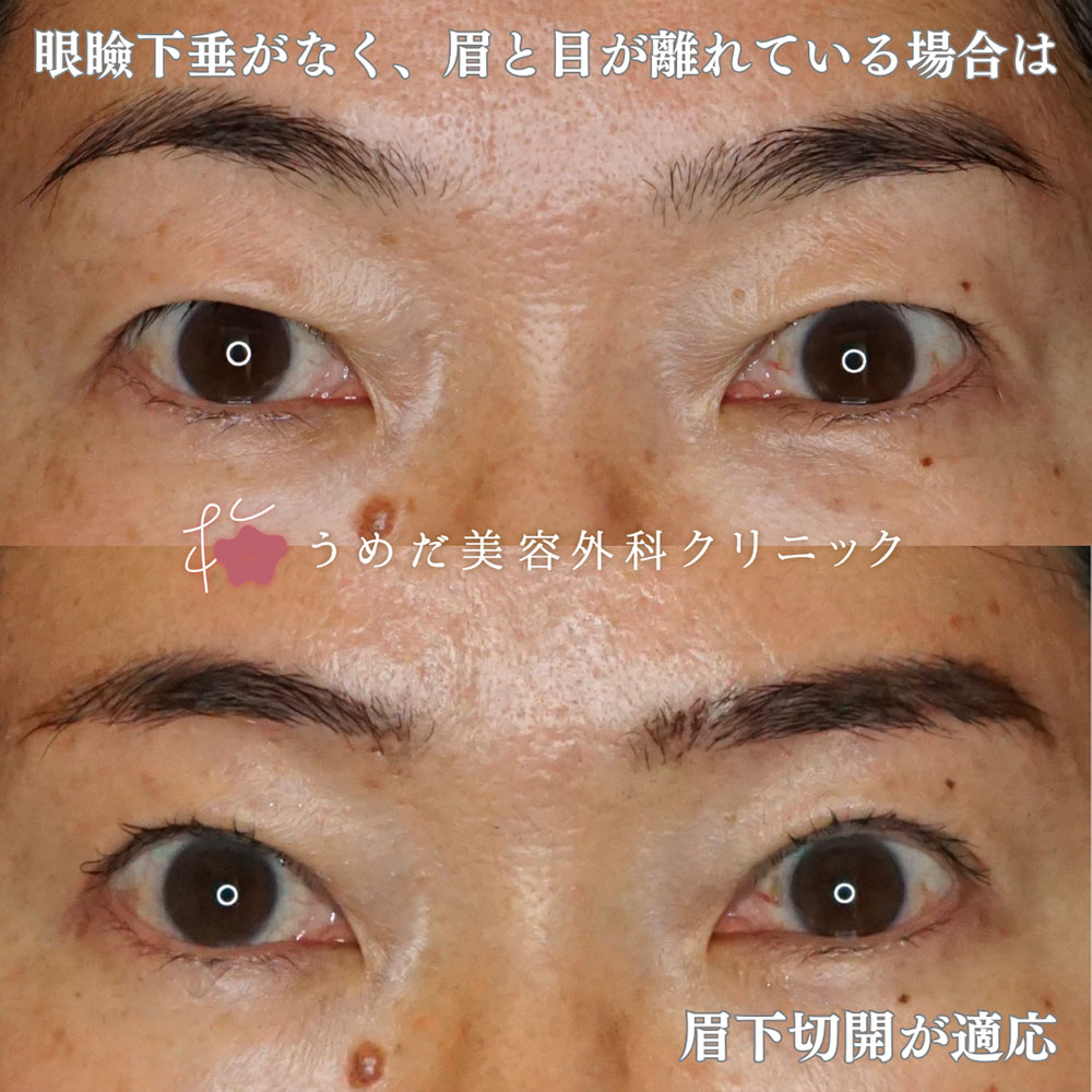 眉下切開1 50代
