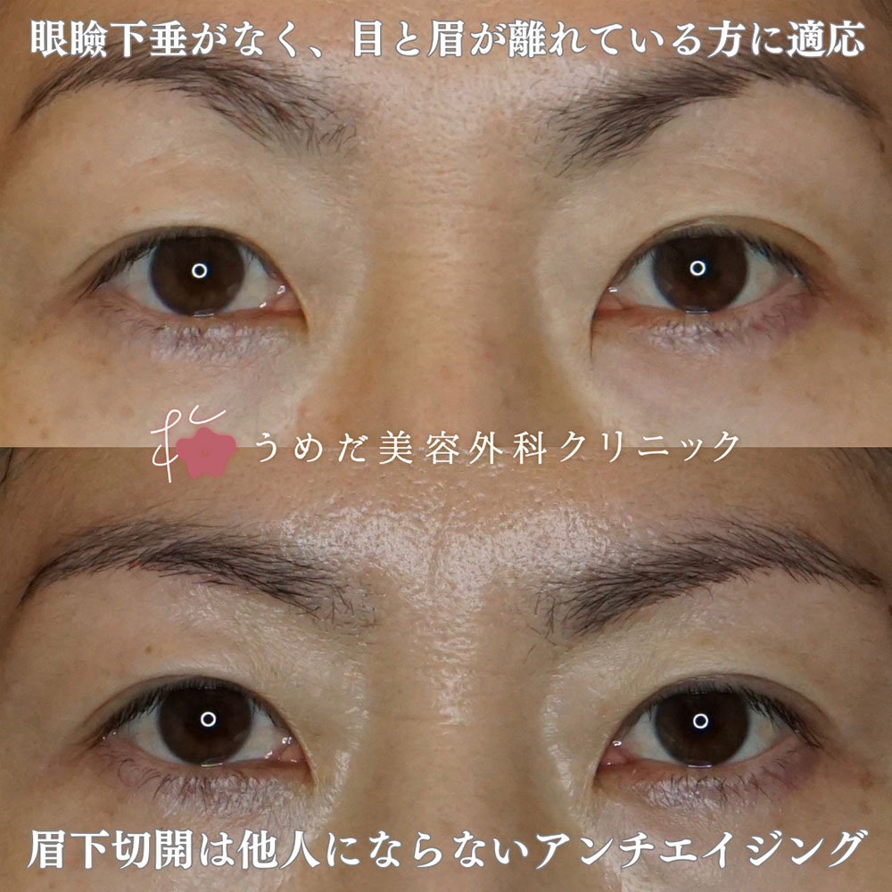眉下切開2 50代