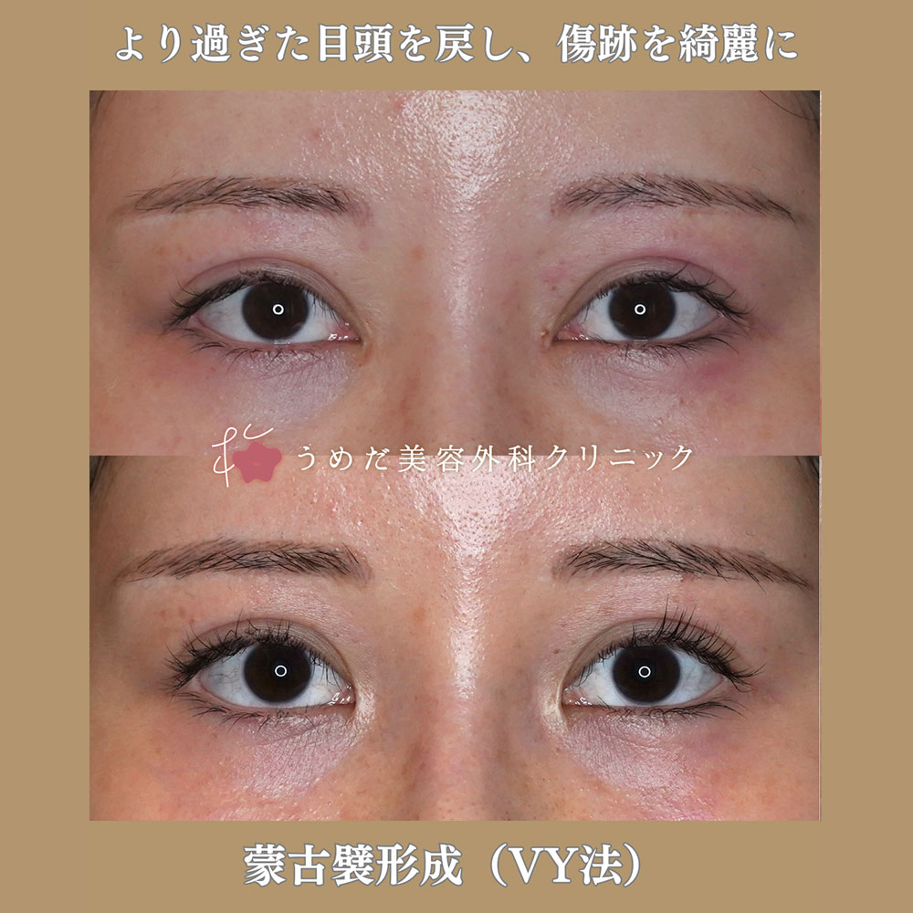 蒙古襞形成 VY法