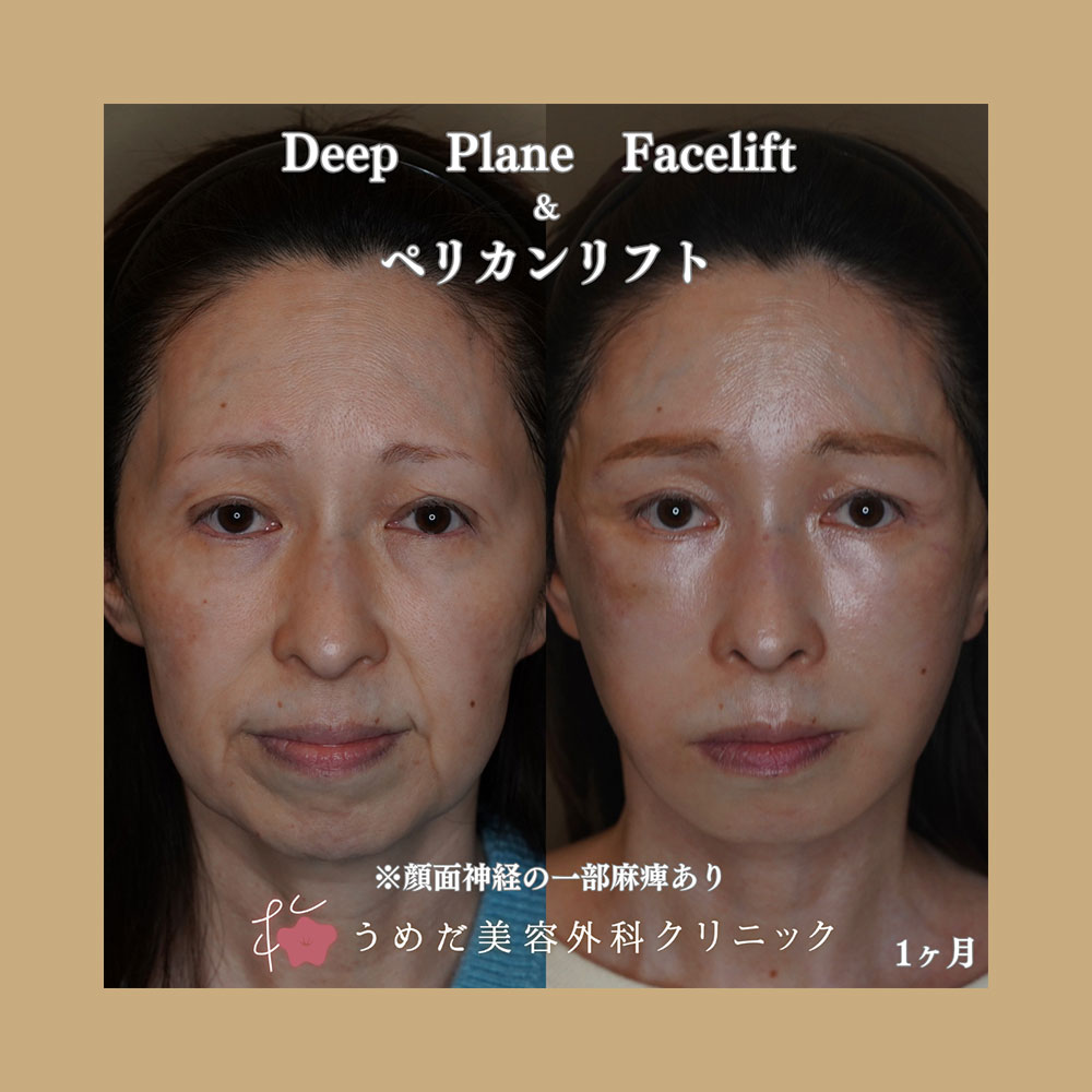 フェイスリフト 50代