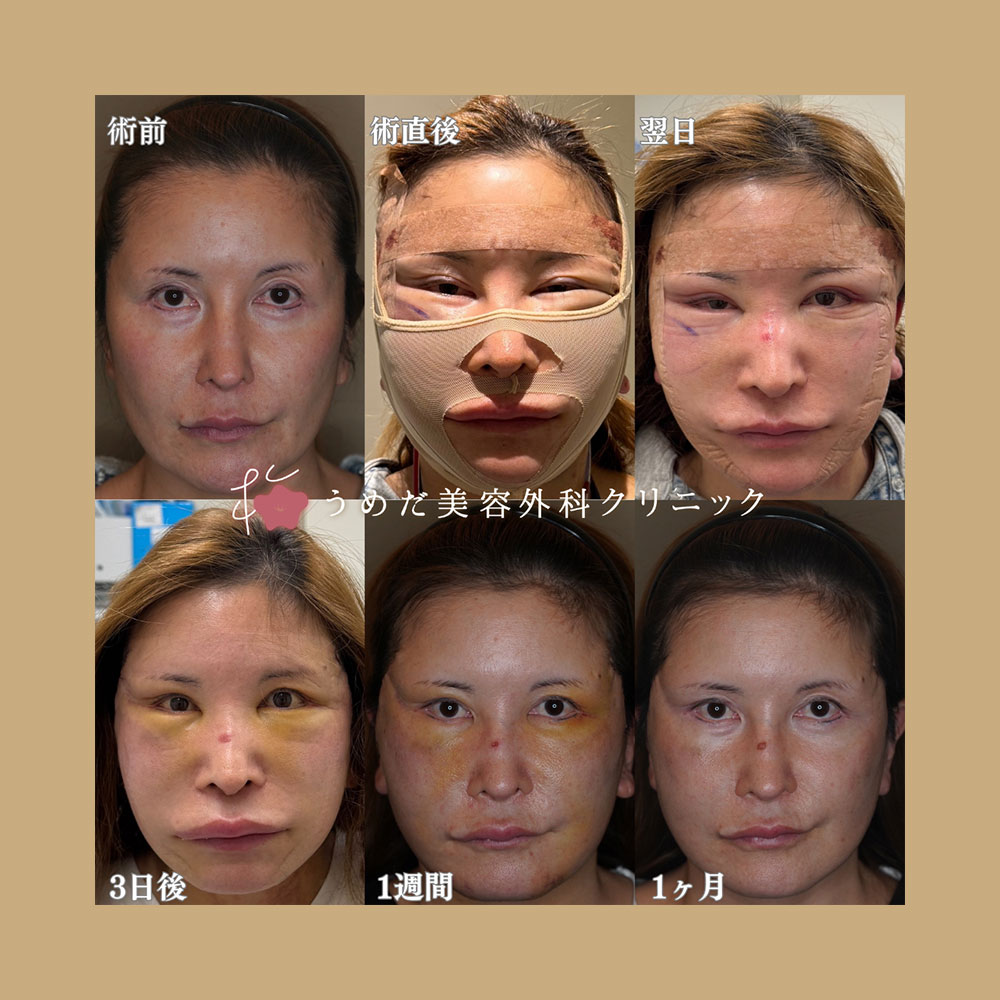 フェイスリフト 50代