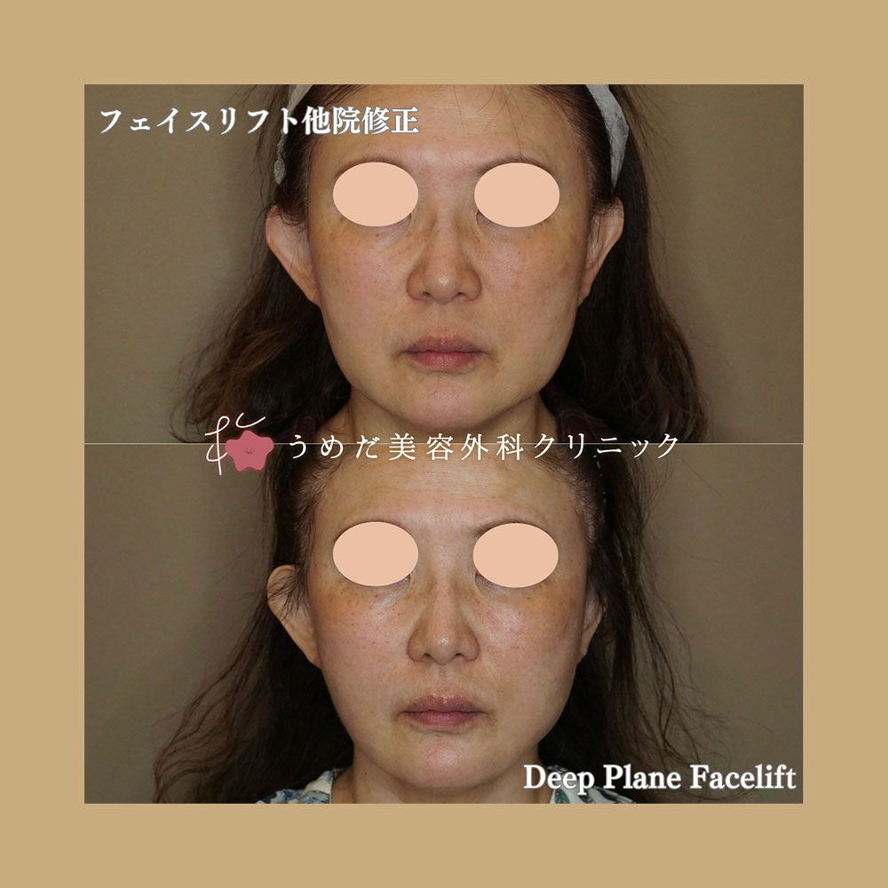 フェイスリフト 50代