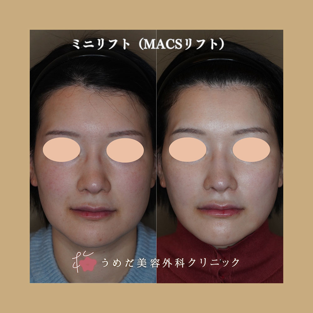 フェイスリフト 40代