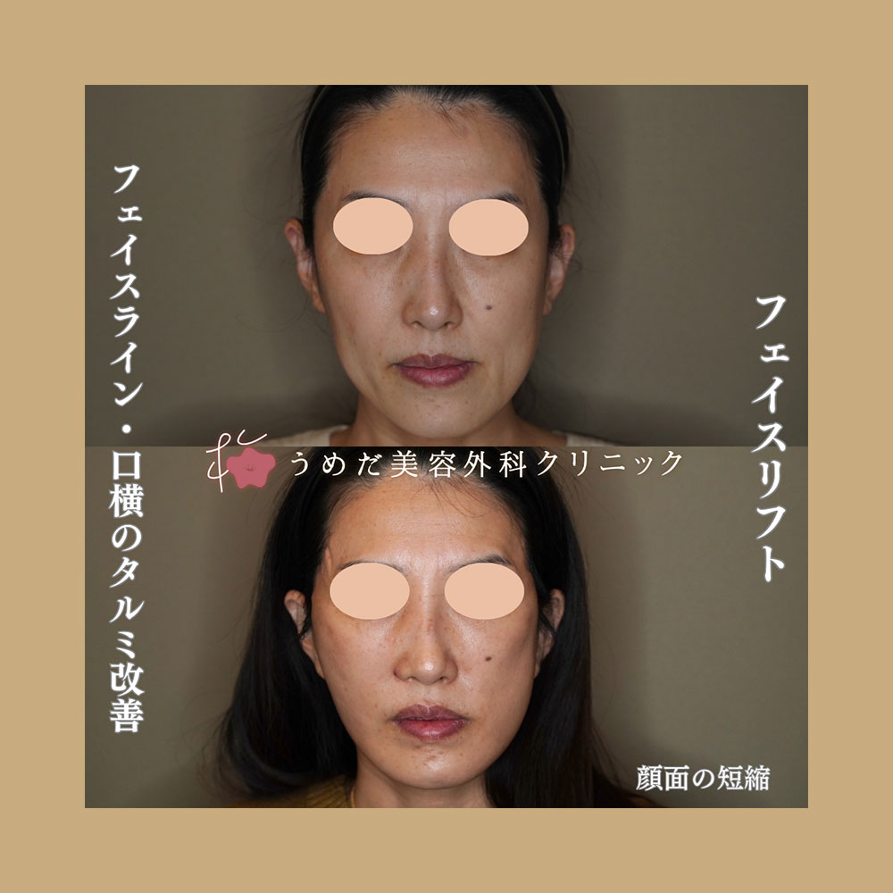 フェイスリフト 40代