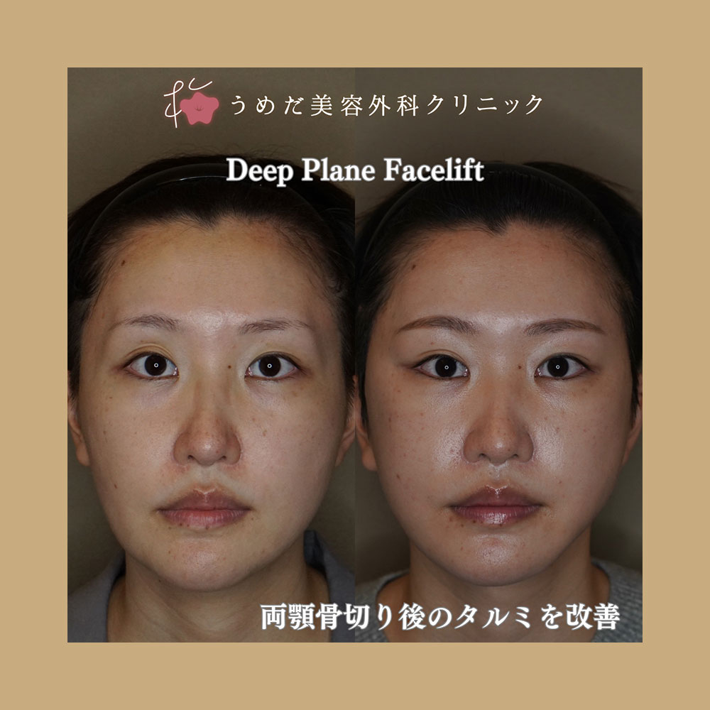 フェイスリフト 20代