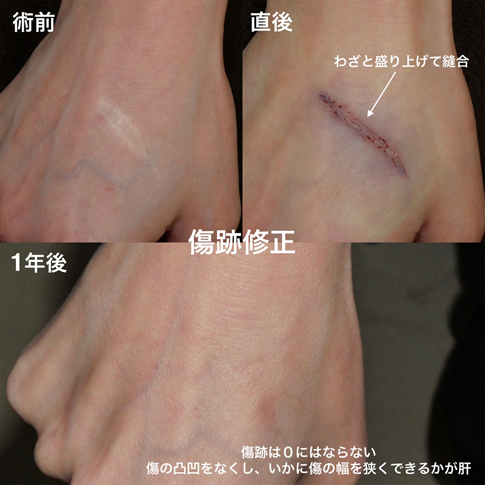 傷跡修正2